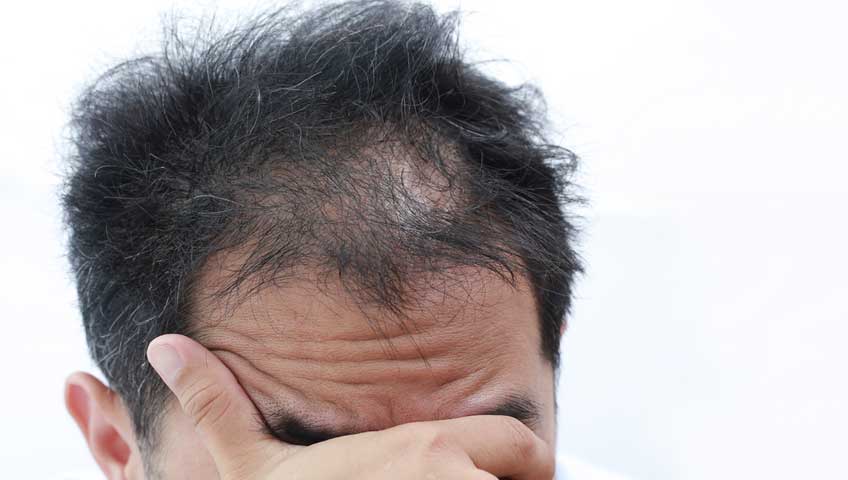 Saç Dökülmelerinin Nedenleri